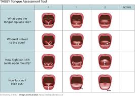 How do you know if your tongue is tied? The Development And Evaluation Of A Picture Tongue Assessment Tool For Tongue Tie In Breastfed Babies Tabby International Breastfeeding Journal Full Text