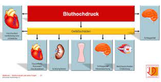 Arterielle Hypertonie Grosstes Kommunales Krankenhaus In Nrw