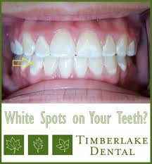 White Spots On Your Teeth Here S What You Need To Know Stained Teeth Teeth Tooth Colored Fillings