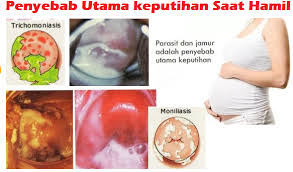 Salah satu hal yang kerap dialami ibu hamil, yakni terjadinya keputihan atau peningkatan kadar estrogen dan aliran darah melalui vagina. Cara Mengatasi Keputihan Saat Hamil Tua Cara Mengobati Penyakit Keputihan
