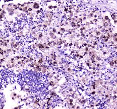 In people with this condition, abnormal lipid. Niemann Pick C2 Npc2 Antibody A01582 2