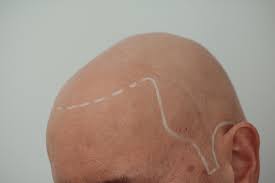Alopecia universalis (au), also known as alopecia areata universalis, is a medical condition alopecia universalis can occur at any age, and is currently believed to be an autoimmune disorder. Alopecia Universalis Komplette Haarlosigkeit Am Ganzen Korper