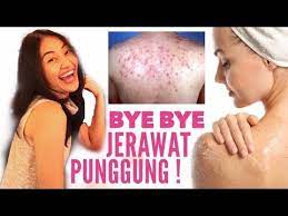 Lemon adalah salah satu agen pemutih alami, kandungan vitamin c pada lemon. Cara Menghilangkan Jerawat Punggung Clarin Hayes Youtube