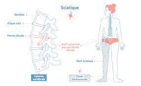 Posted by admindosmal49posted on 21 janvier 2016. Fessier Jambe Pied Comment Soulager La Douleur Du Nerf Sciatique Traitements Soins Essentiel Sante Magazine