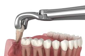 Image result for Tooth Extraction