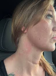 What causes sudden burning hot rash?