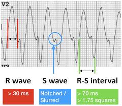 Pin By Deb Kohler On Ecg Interpretation Cardiac Sonography Medical Mnemonics Medical