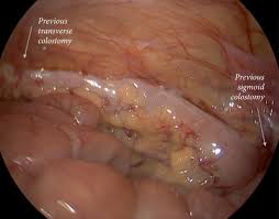 He had an academic appointment as assistant professor at the university of massachusetts medical school. Colostomy Takedown Ischemic Complication Following Anorectal Malformation Surgery