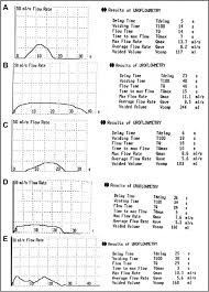 The Postoperative Uroflow Patterns A A Bell Shaped Curve