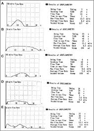 The Postoperative Uroflow Patterns A A Bell Shaped Curve