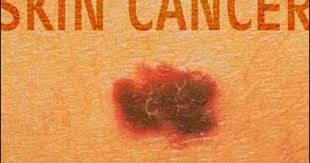 To help care for your skin during the coronavirus. Skin Cancer In Kids On The Rise Cbs News