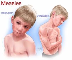 Image result for measles