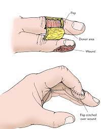 Fingertip Injuries And Amputations - Orthoinfo - Aaos