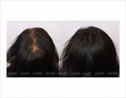 Pcos Hair Loss Regrowth Success Before And After Hairlosshomeremedies Hairlosswomenremedies Pcos Hair Loss Hair Loss Remedies Hair Loss Regrowth