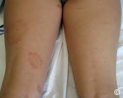 Image result for Pigment stains on the shin