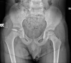 Click on the link to go to. Orthokids Perthes Disease