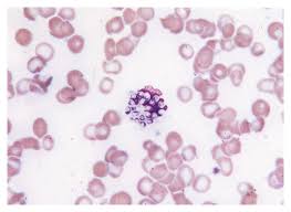 Image result for Peripheral Smear