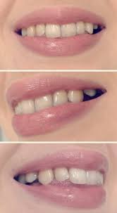4 offers from $18.99 #14. Lingual Braces Blog Inside I M Smiling