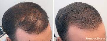 Minoxidil is in the class of treatments called potassium channel openers. Propecia Rogaine Before After Photos Bernstein Medical