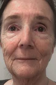 Photobiomodulation: The Clinical Applications of Low-Level Light Therapy