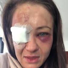 Gamrot trafił palcem w oko irlandczyka, zaś decyzją sędziego marca goddarda walka została uznana za. Karolina Kowalkiewicz W Zlym Stanie Lodzianka Z Ufc W Szpitalu Moze Stracic Wzrok Wideo Lodz Super Express
