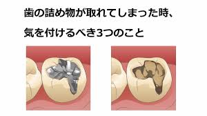 歯の詰め物が取れてしまった時、まず気をつをつけるべき3つのこと | 八島歯科クリニック