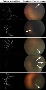 Deepfakes in Ophthalmology - Ophthalmology Science