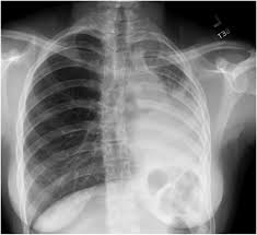 Read about pneumonia, including symptoms, causes, who's at risk, treatment and possible complications. Case 1 Recurrent Pneumonia In A 15 Year Old Girl American Academy Of Pediatrics