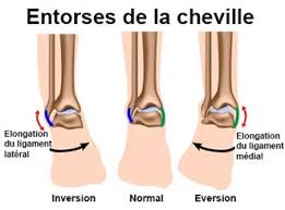 Plusieurs causes peuvent être à l'origine de vos douleurs à la cheville, telles qu'une hyperlaxité ligamentaire ou une instabilité. Douleurs De La Cheville Symptomes Traitement Definition Docteurclic Com