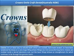 After root canal treatment what to eat. Emergency Root Canal Treatment Smile Craft Dental