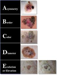 Melanoma skin cancer has a rapid growth rate, which is what makes it so dangerous; Stage Melanoma Semantic Scholar