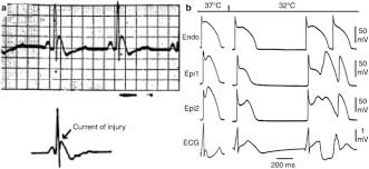 Image result for Early Repolarization