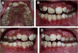 How do you fix crossbite? Simple Removable Appliances To Correct Anterior And Posterior Crossbite In Mixed Dentition Case Report Sciencedirect