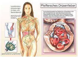 Eine infektion damit macht im grunde quasi jeder durch. Pfeiffersches Drusenfieber Ursachen Symptome Behandlung Medlexi De