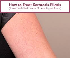 Red bumps on your face can have a variety of causes. How To Treat Keratosis Pilaris Those Scaly Red Bumps On Your Upper Arms Keratosis Pilaris Treat Keratosis Pilaris Health And Beauty