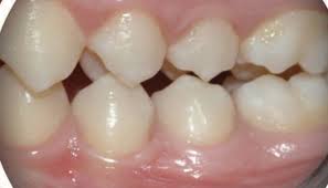 Image result for Occlusal