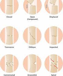 A Quick Summary Of The Different Types Of Fracture That Can Occur Firstaid Cpr Fracture Fractures Brok First Aid Tips Types Of Fractures Nursing Students