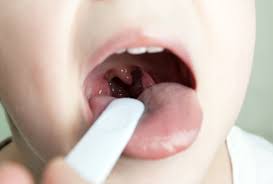 Have you ever had irritation or discomfort in your throat and weren't sure if if it was plaque? An Ent Tells You How To Get Rid Of Tonsil Stones