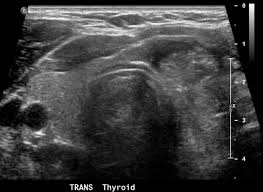 They may be hyperplastic or tumorous, but only a small percentage of thyroid tumors are malignant. Figure Left Thyroid Nodule With Microcalcifications Contributed By Ahmet Selcuk Can Statpearls Ncbi Bookshelf