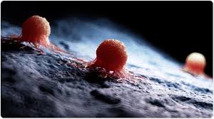 Lung cancer occurs when cells in the lung mutate or change. What Are Carcinomas