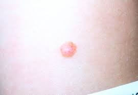 Image result for Spitz Nevus