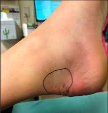 Image result for Snake Bite