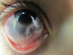 Image result for melanosis sclera
