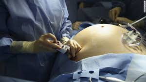 BARİATRİC SURGERY ile ilgili görsel sonucu