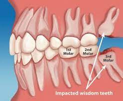 Wisdom Teeth Grow In At The Back Of The Mouth Behind Your Molars They Often Grow In Crooked Sidew Impacted Wisdom Teeth Wisdom Tooth Extraction Wisdom Teeth
