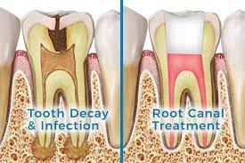 Do Root Canals Hurt