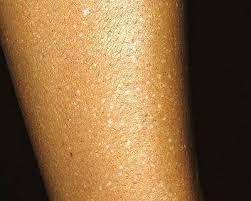 Pielea inconjuratoare are un aspect stralucitor ca de portelan diabetul poate provoca multe alte probleme ale pielii. Pete Galbene Pe Piele Cauze