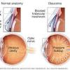 The best way to preserve vision is through annual, detailed eye exams with a doctor who specializes in your unique eye condition. 1