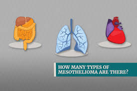 Mesothelioma cancer develops after a person is exposed to asbestos fibers. How Many Types Of Mesothelioma Are There Bullock Campbell Bullock Harris Pc