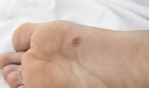 Bleeding nails (24) infected, swelling, or redness around nail (24) Skin Cancer Symptoms A Brown Or Black Vertical Line Under A Toenail Could Be A Sign Express Co Uk